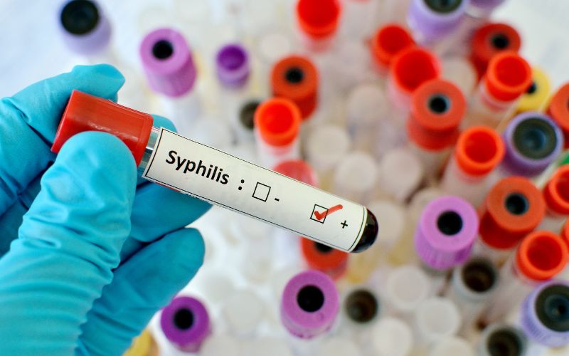 Casos de sífilis atingem novo recorde no Japão, imagem mostra tubo de ensaio com etiqueta de sífilis positivo